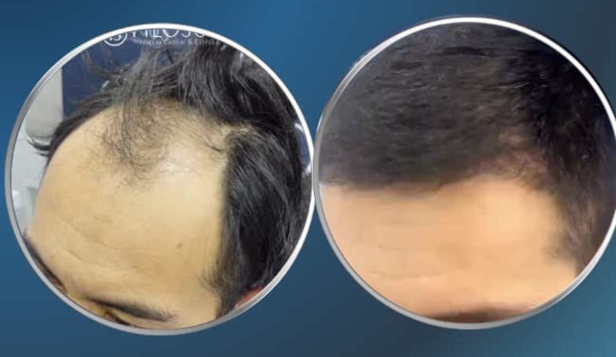 نتائج زراعة الشعر بتقنية FUE قبل وبعد – استعادة خط الشعر وتغطية أكثر كثافة
