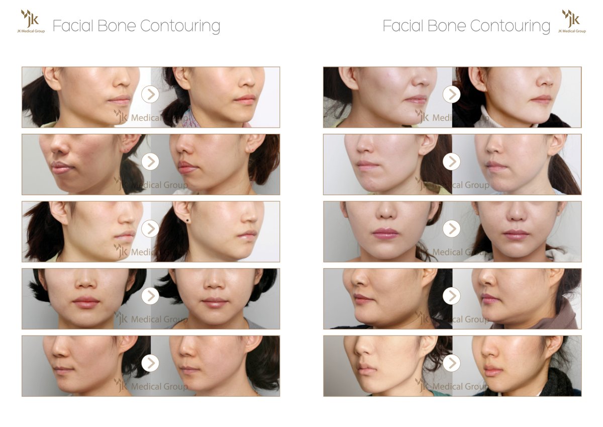 نتائج قبل وبعد نحت عظام الوجه في JK Plastic Surgery Center، إعادة تشكيل الفك