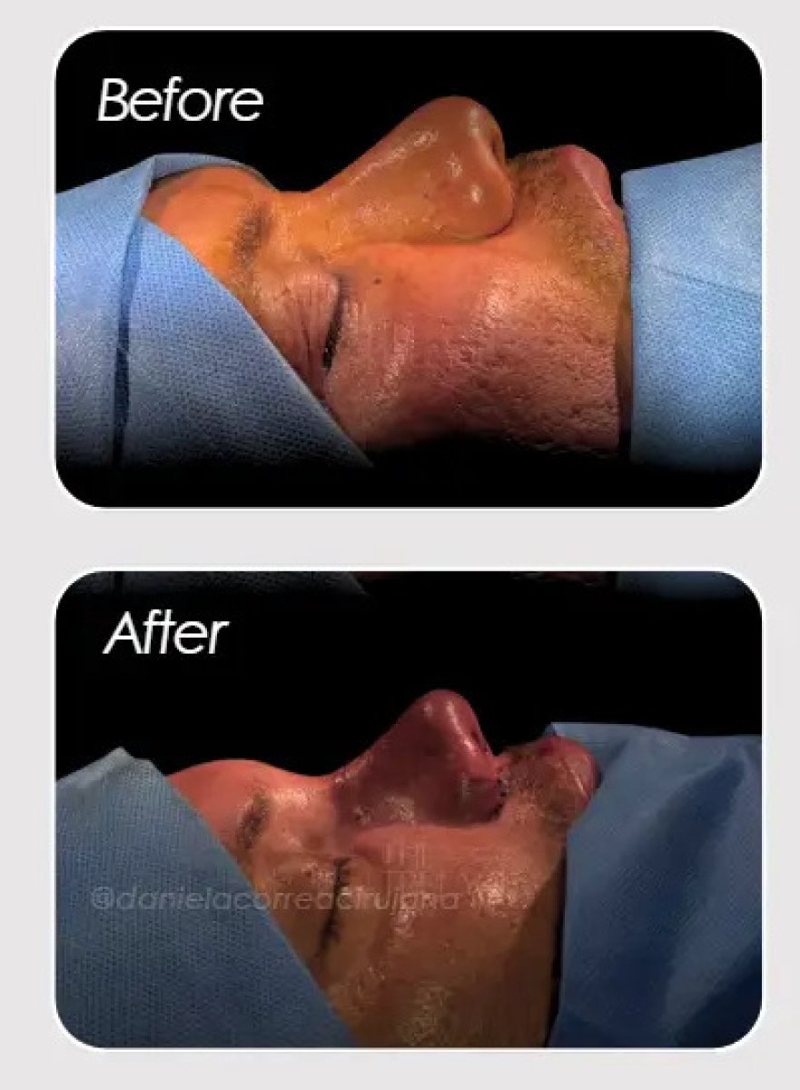 Before and after rhinoplasty results – nose reshaping with improved profile