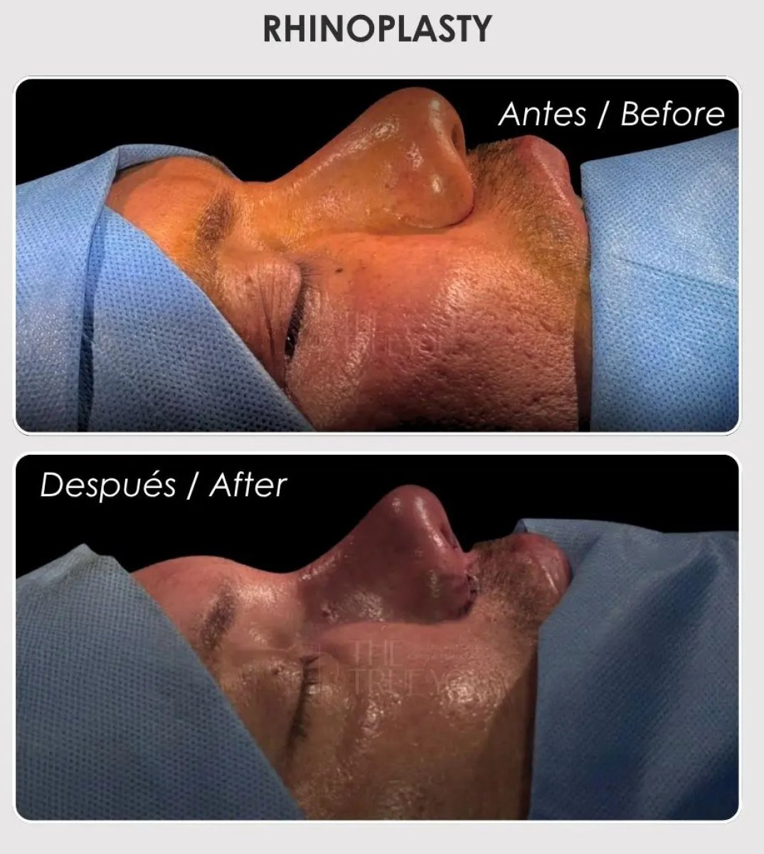Before and after rhinoplasty results – improved nose shape and profile after surgery