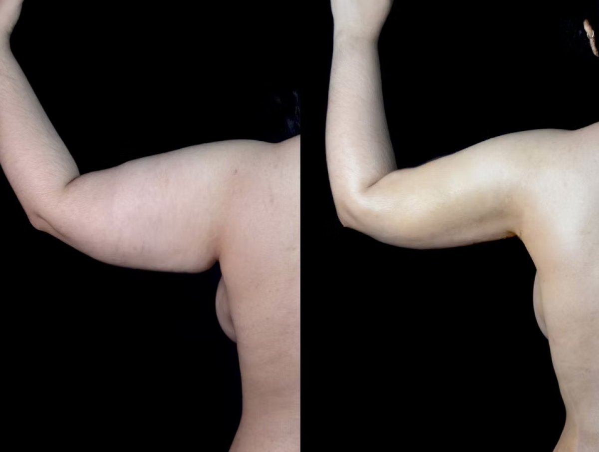 Vorher-nachher-Ergebnis Armlifting (Brachioplastik) – verbesserte Armkontur