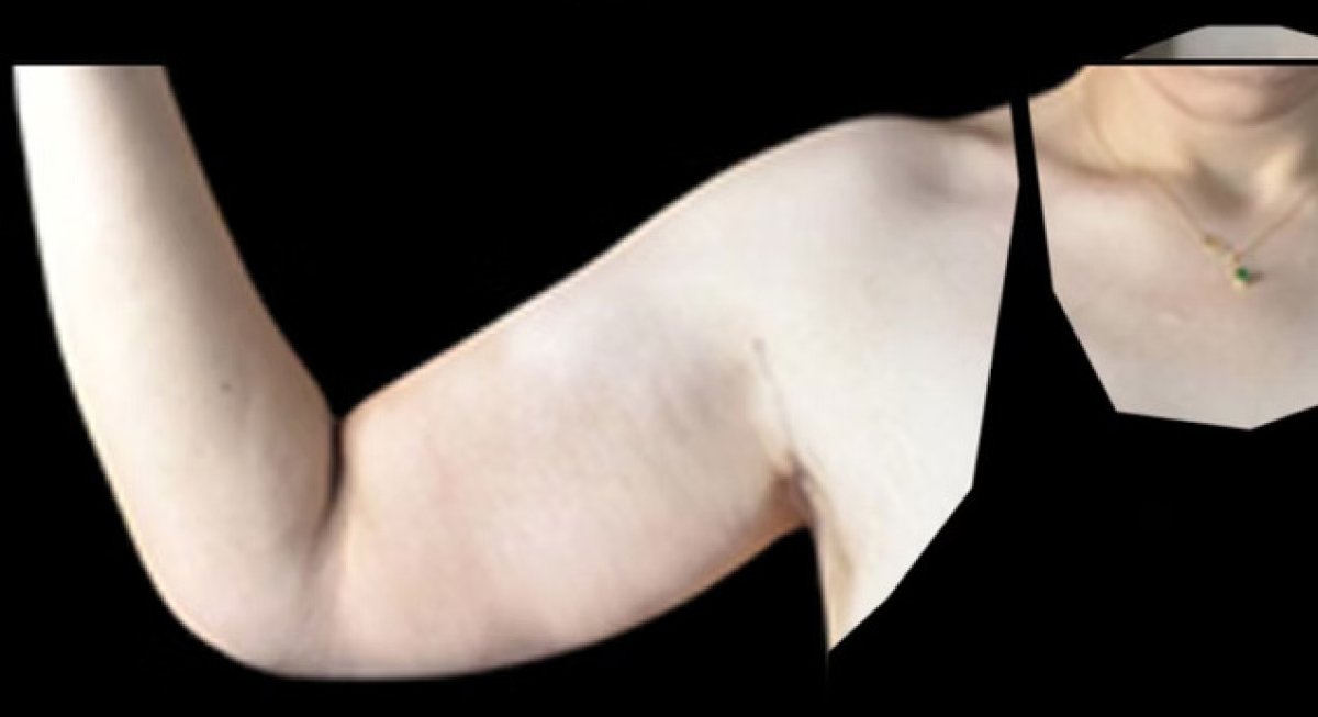 Resultado antes de lifting de brazos (braquioplastia): piel flácida visible en el brazo superior