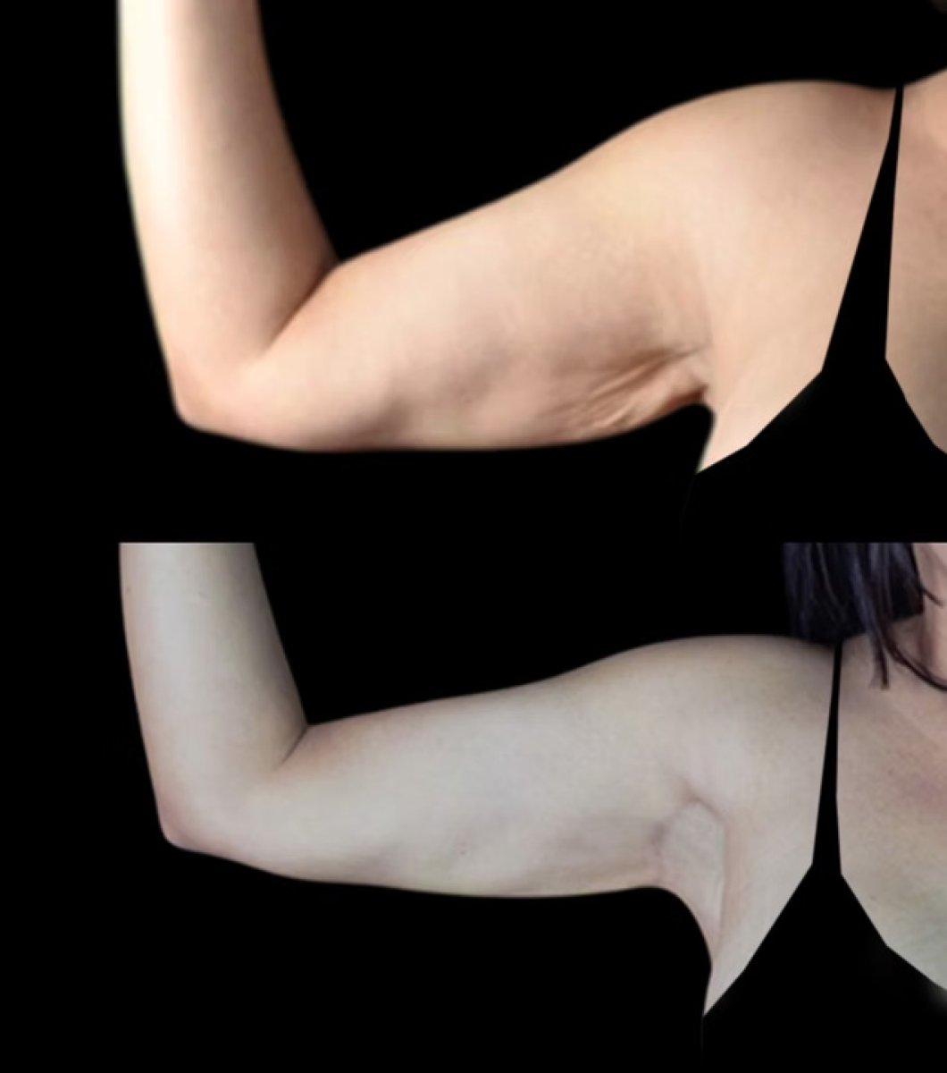 Vorher-nachher-Ergebnis Armlifting (Brachioplastik) – verbesserte Armkontur