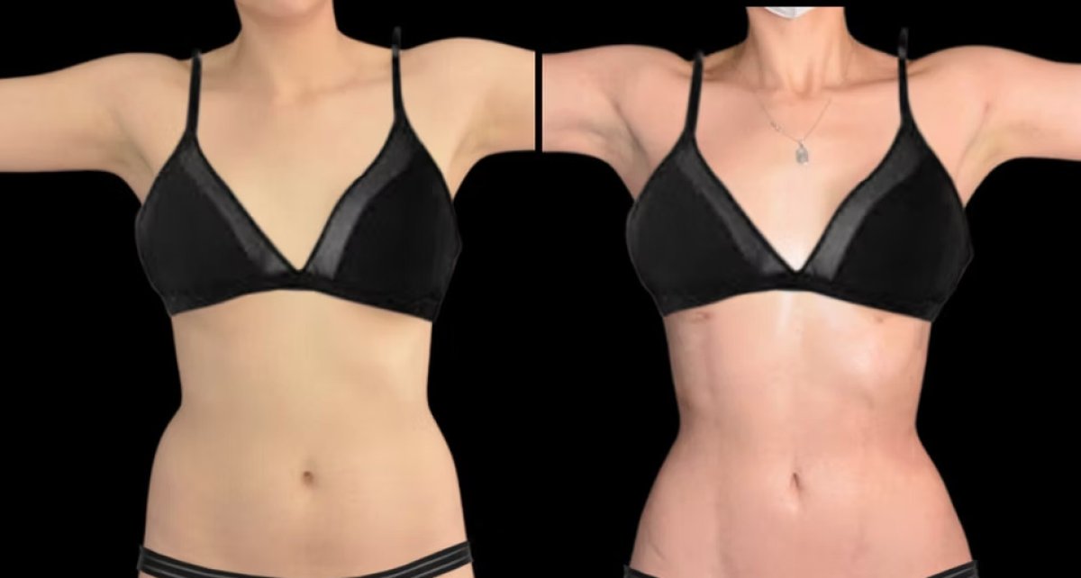 Resultados de liposucción antes y después: mejora visible del contorno de cintura y abdomen