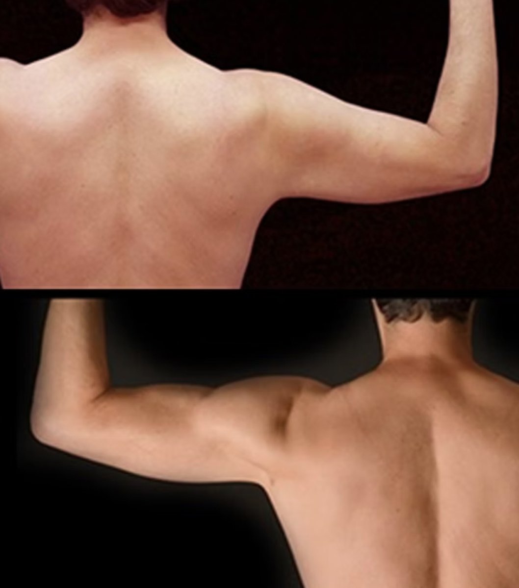 Resultados de liposucción de brazos antes y después – mejor definición muscular