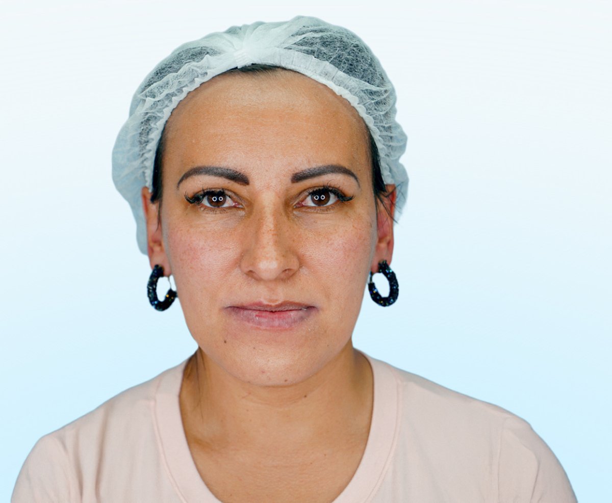 After rhinoplasty result, nose reshaping for improved facial harmony at the clinic