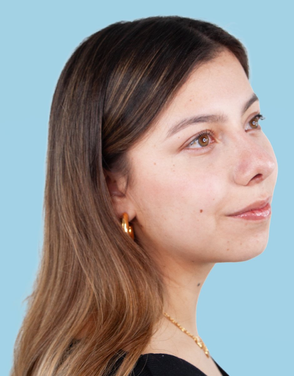 Resultado de rinoplastia en paciente femenina, remodelación natural de la nariz