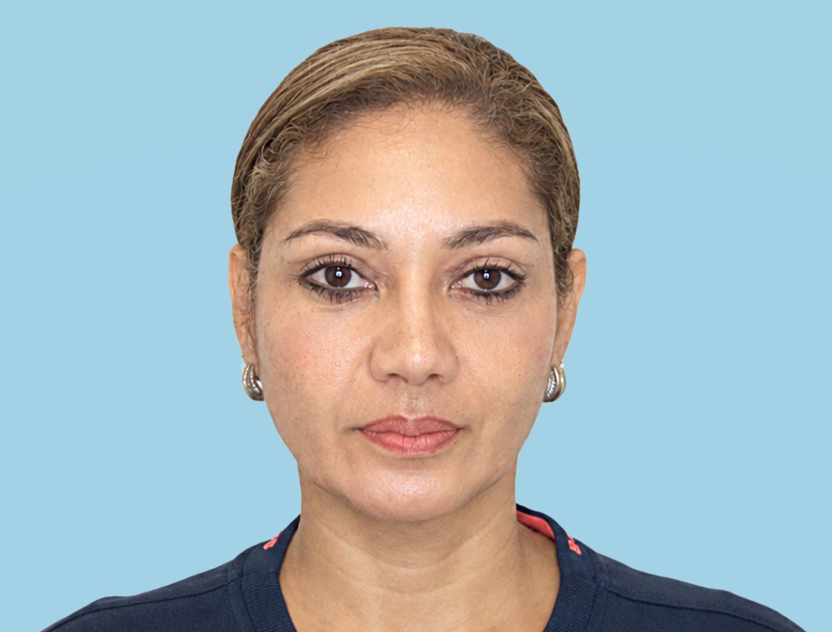 Brow lift result – rejuvenated forehead and lifted brows after cosmetic procedure
