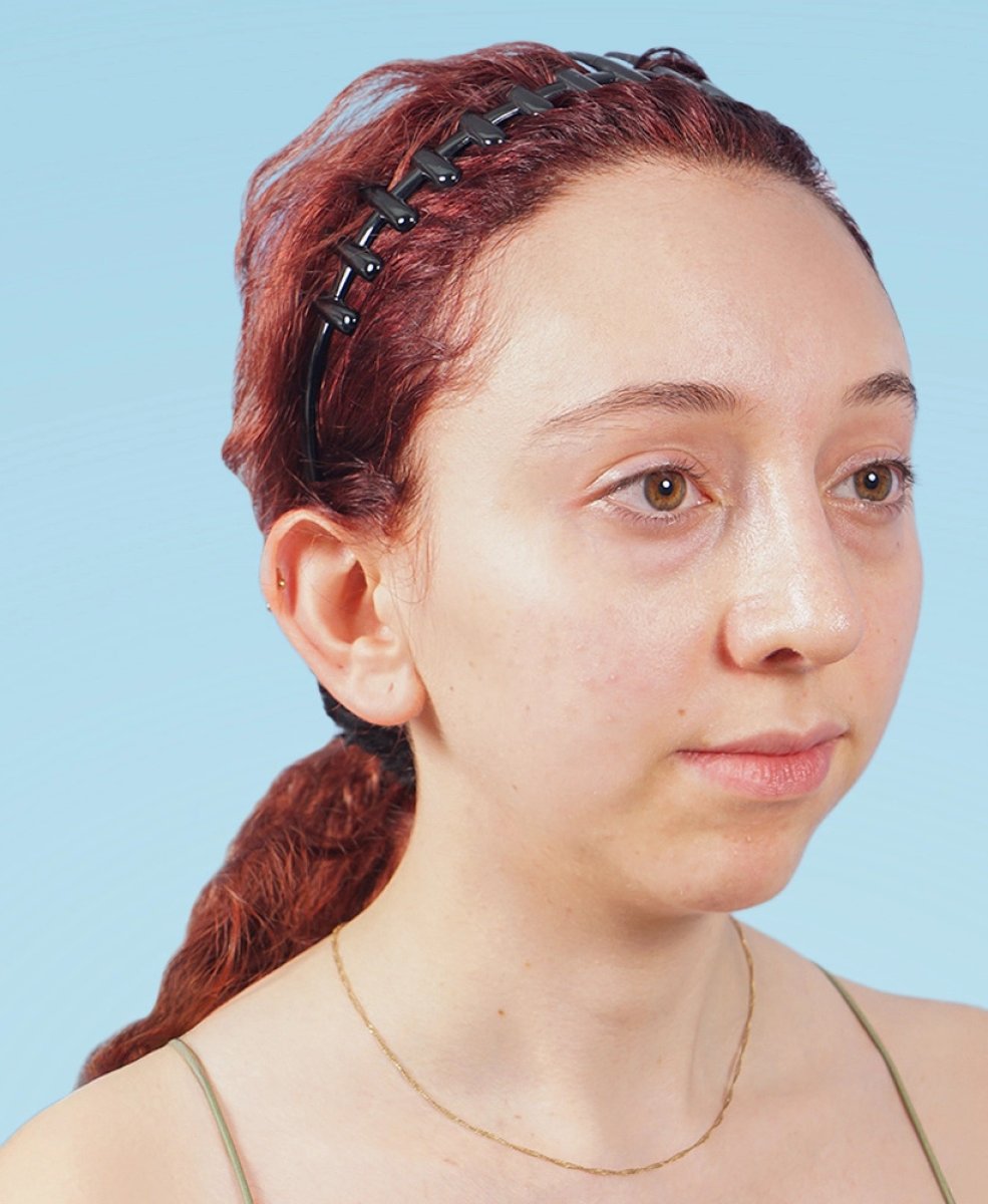 Resultado después de rinoplastia, remodelación natural de la nariz y armonía facial