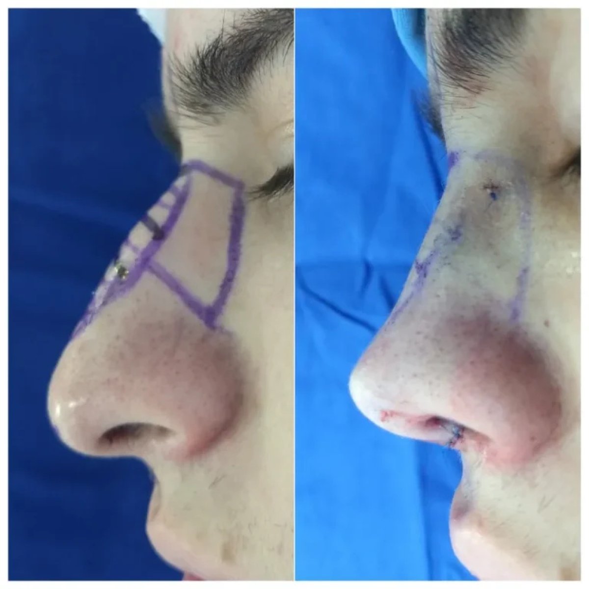 نتائج قبل وبعد إزالة حدبة الأنف، تحسين شكل الأنف بعد عملية تجميل الأنف