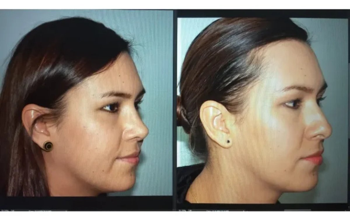 Vorher-nachher-Ergebnis Nasenhöckerentfernung, verbesserte Nasenprofil nach Rhinoplastik