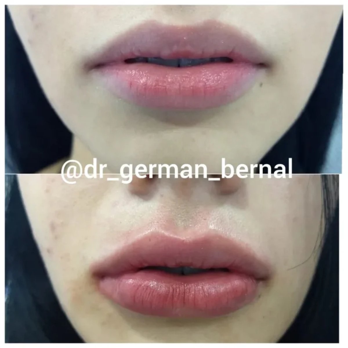 نتيجة حقن فيلر الشفاه قبل وبعد لدى Dr. German Bernal – زيادة حجم الشفاه