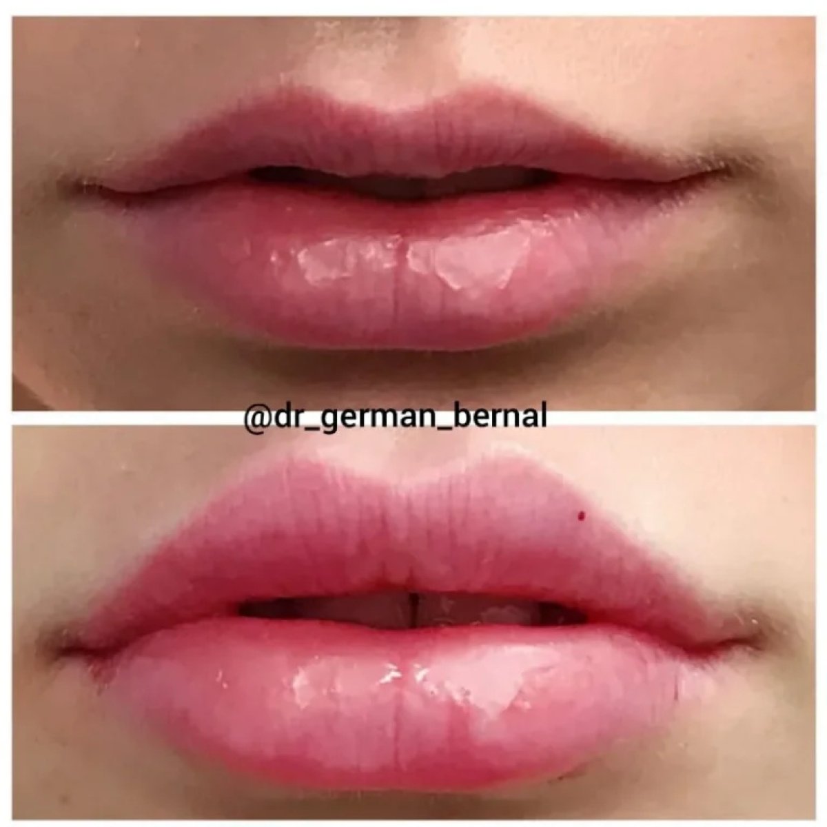 Vorher-nachher-Ergebnis Lippenfiller-Injektion, mehr Volumen und Konturverbesserung
