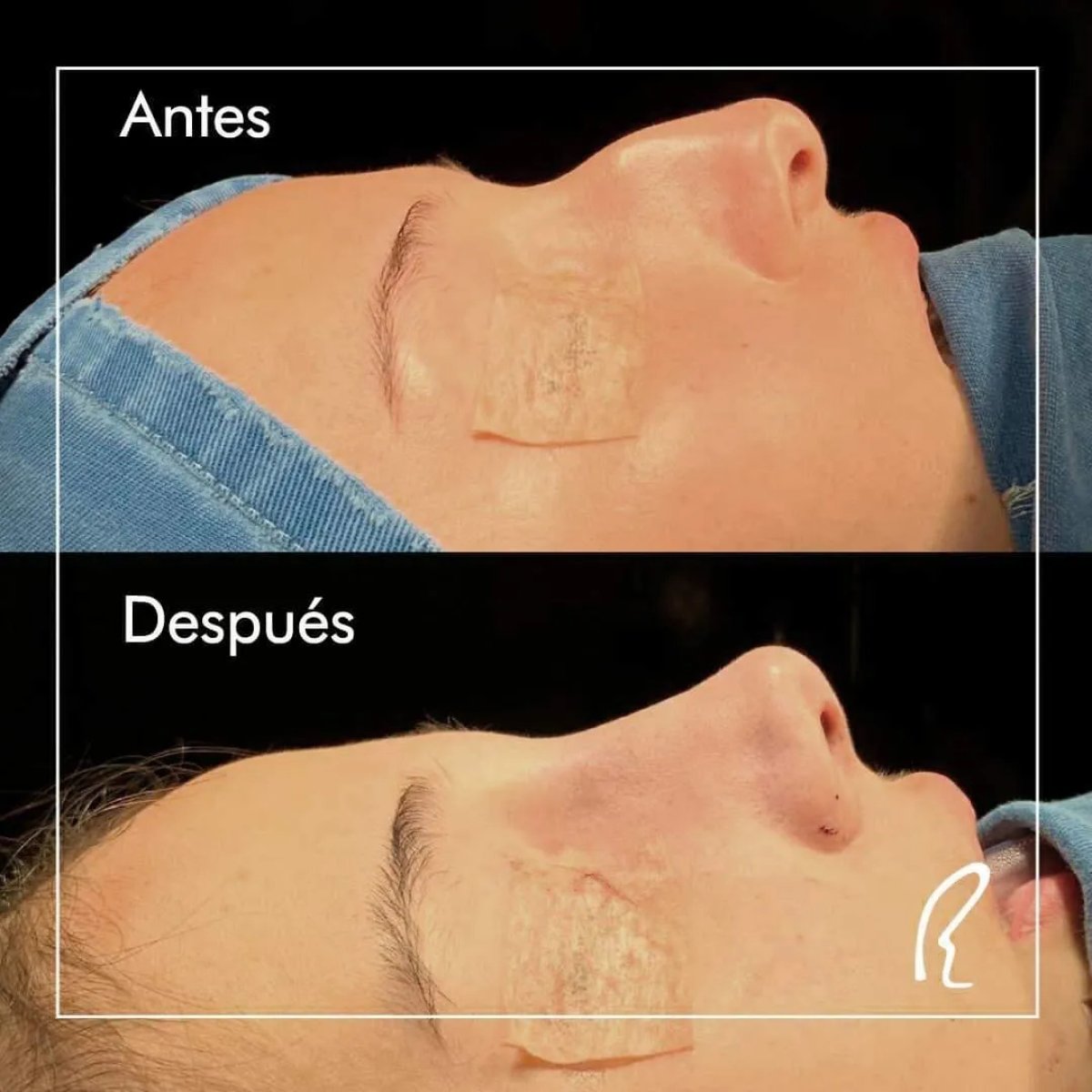 نتائج عملية تجميل الأنف قبل وبعد، إعادة تشكيل الأنف وتحسين المظهر الجانبي