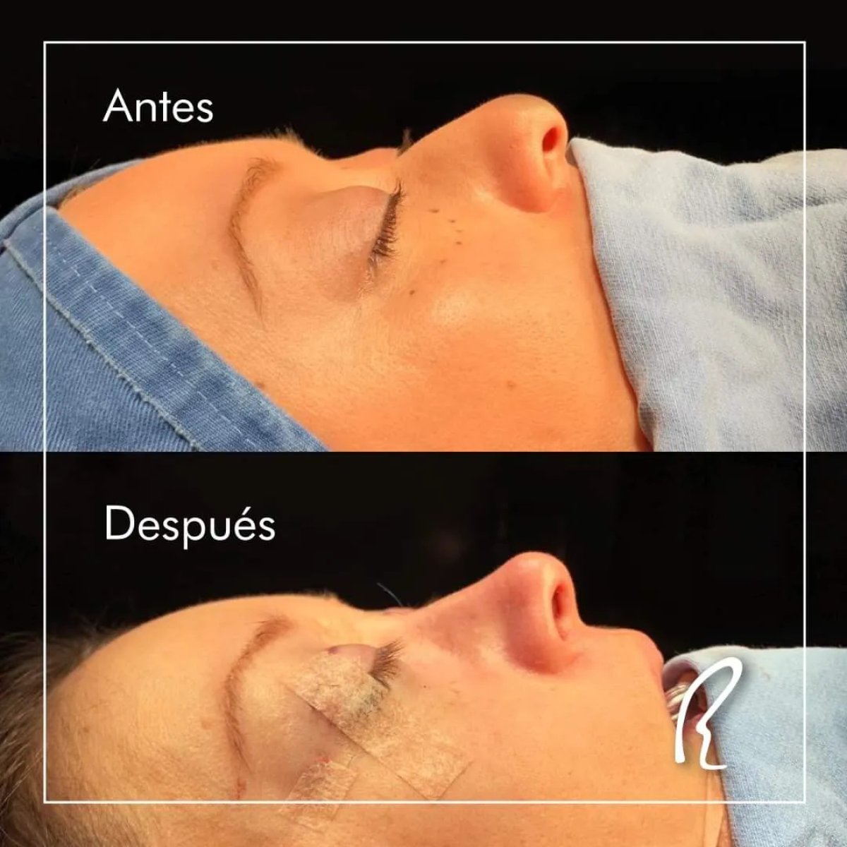 Before and after rhinoplasty results, nose reshaping with improved profile and contour