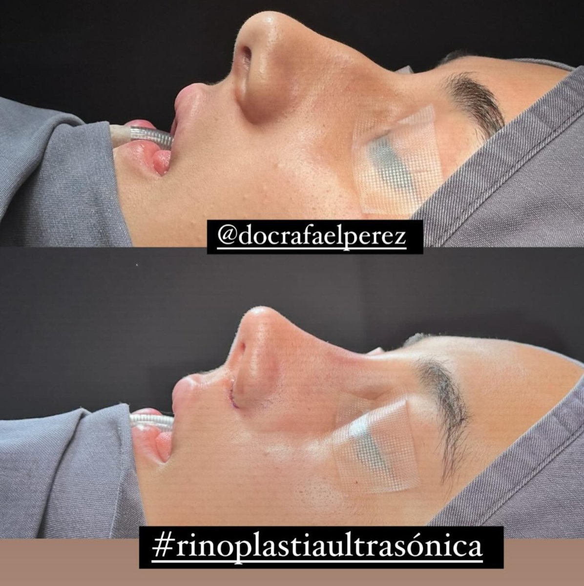Before and after ultrasonic rhinoplasty results by Dr. Rafael Perez, nose reshaping outcome