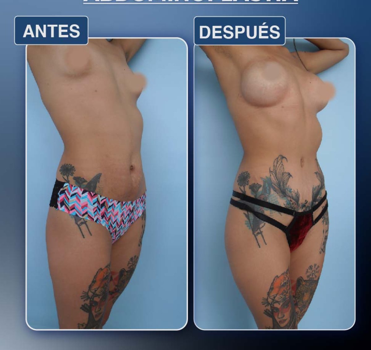 Before and after Vaser lipo 3 areas plus tummy tuck results, improved body contour
