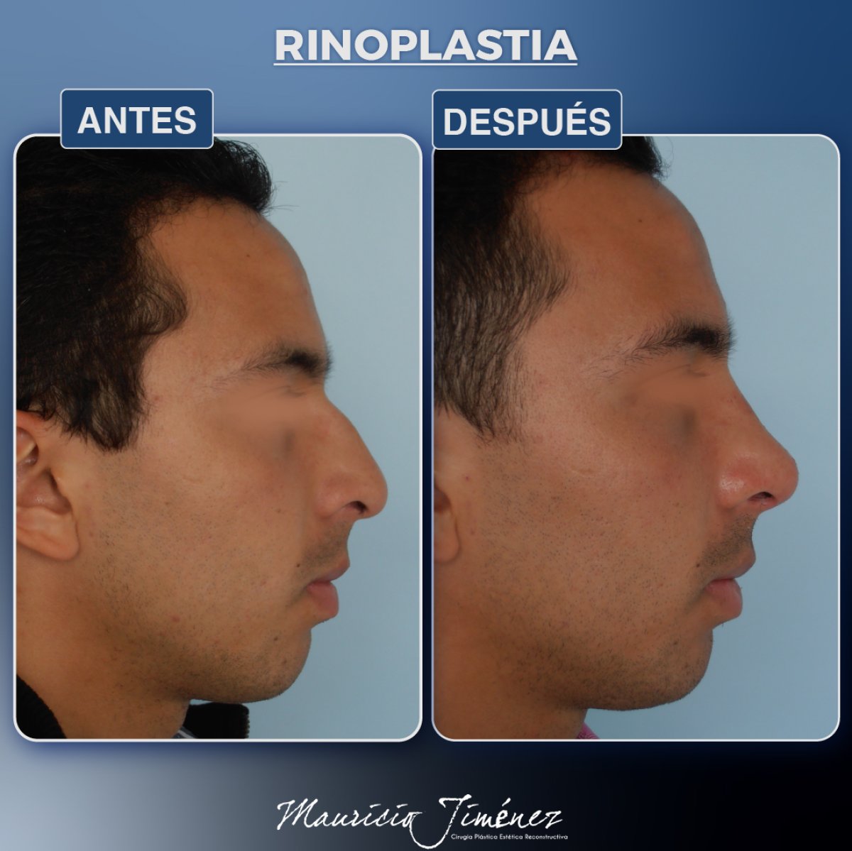 نتائج عملية تجميل الأنف قبل وبعد، إعادة تشكيل الأنف وتحسين المظهر في Mauricio Jiménez