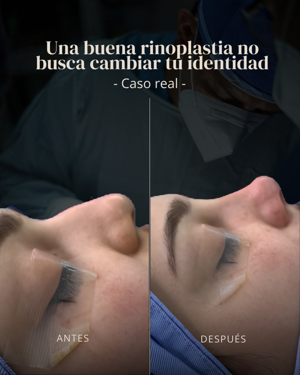 نتائج عملية تجميل الأنف قبل وبعد، إعادة تشكيل الأنف بمظهر طبيعي في العيادة