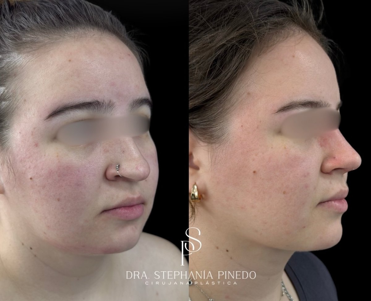 Результати ринопластики до і після у Dra. Stephania Pinedo, покращення форми носа