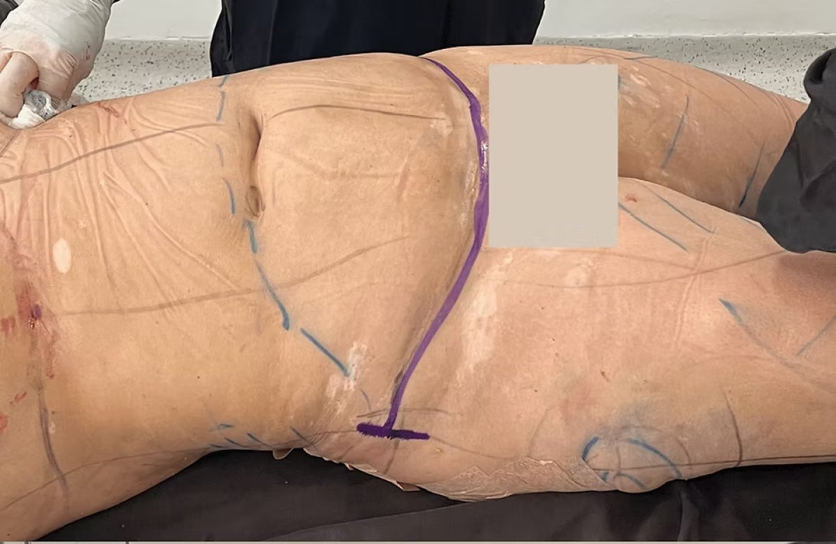 Tummy tuck surgery result with marked incision lines, abdominal contouring procedure