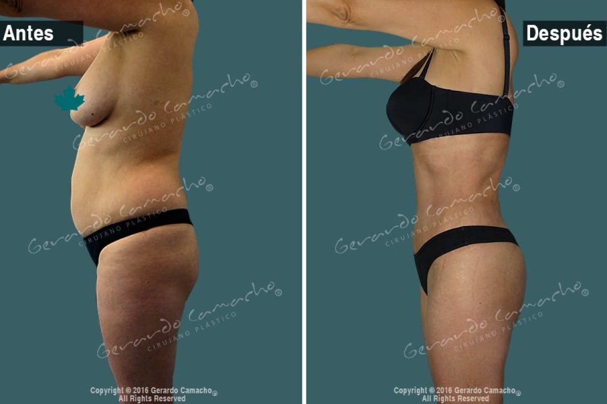 Before and after tummy tuck results at Gerardo Camacho clinic – visible abdominal contouring