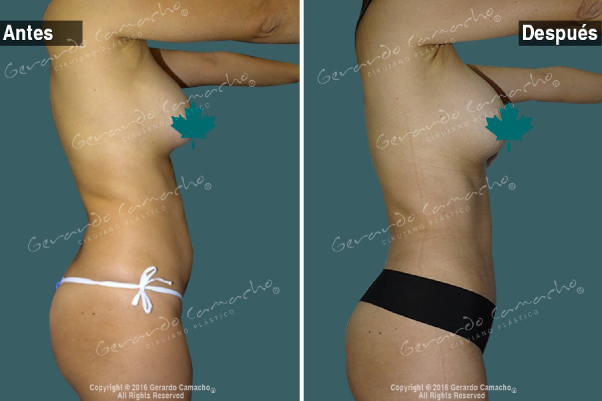 Before and after tummy tuck results at Gerardo Camacho clinic – improved abdominal contour