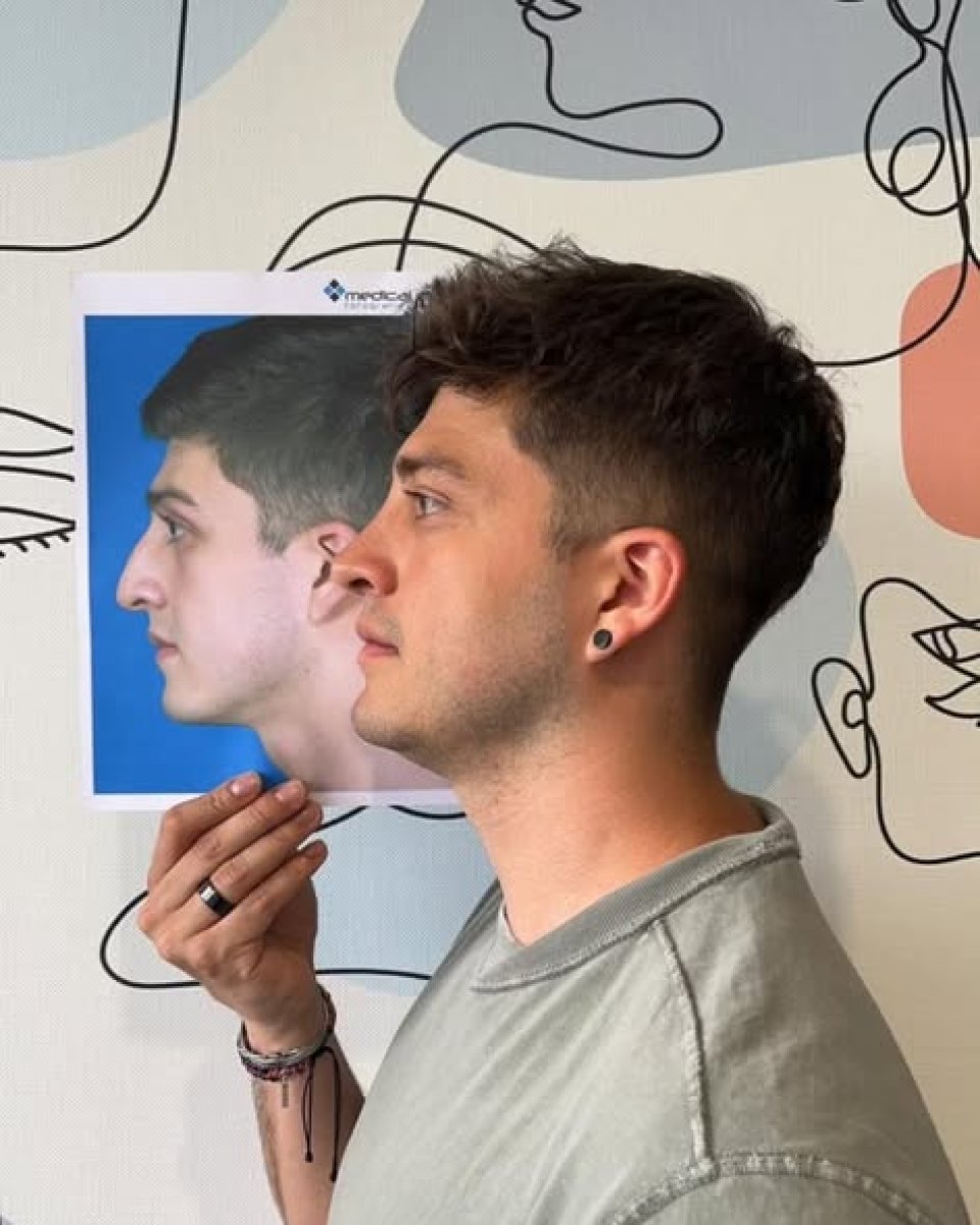 Before and after rhinoplasty results in male patient, improved nose profile and contour