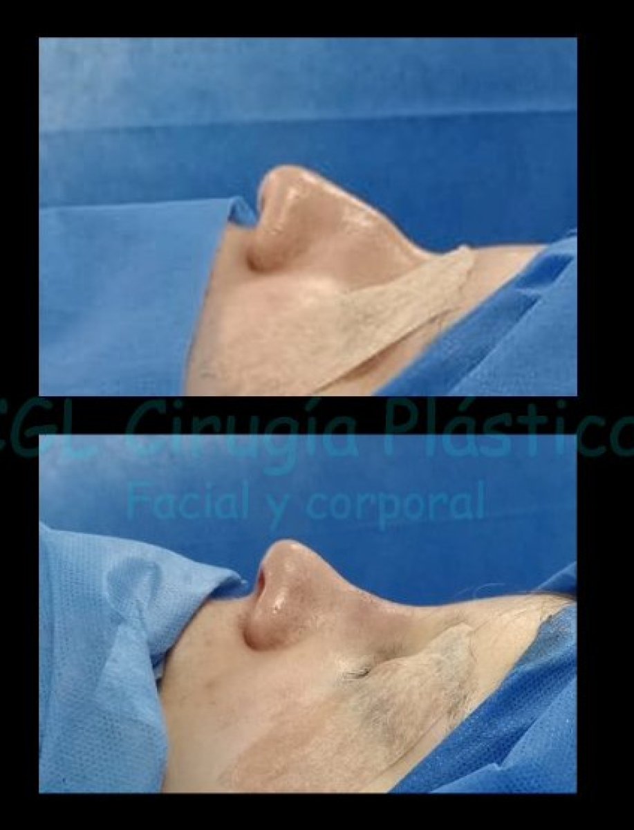 Resultados de rinoplastia antes y después en EGL Cirugía Plástica, mejora de la nariz