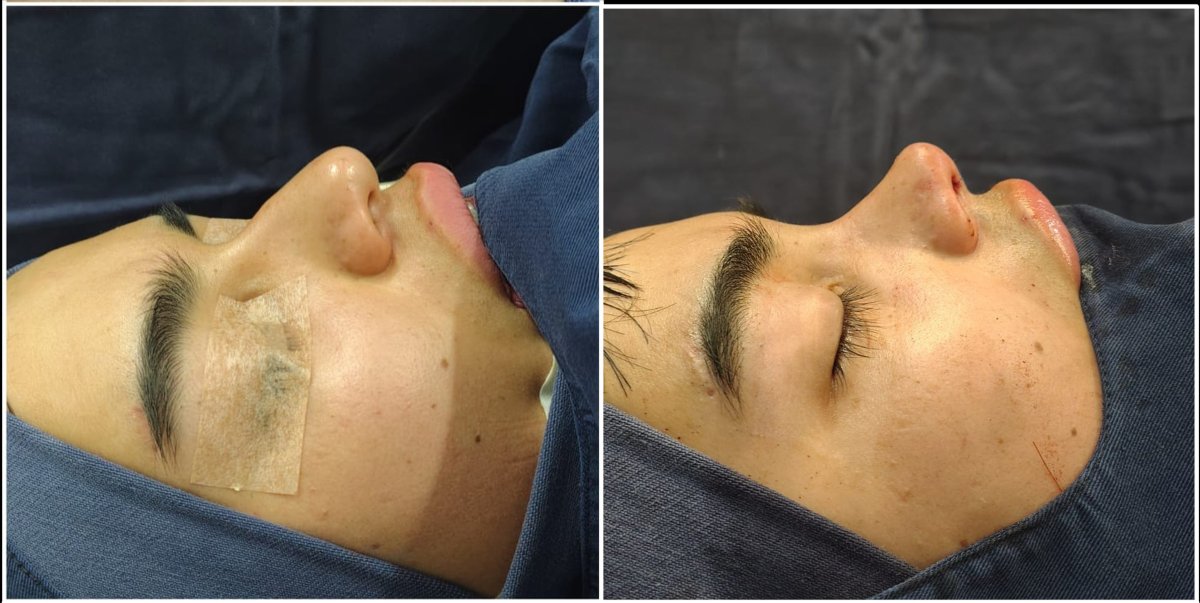Before and after rhinoplasty results, nose reshaping and profile improvement for male patient