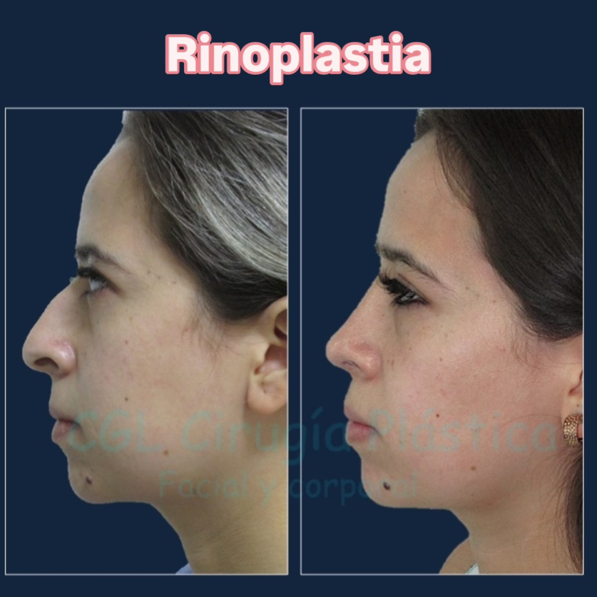 Before and after rhinoplasty results, nose reshaping with natural profile improvement