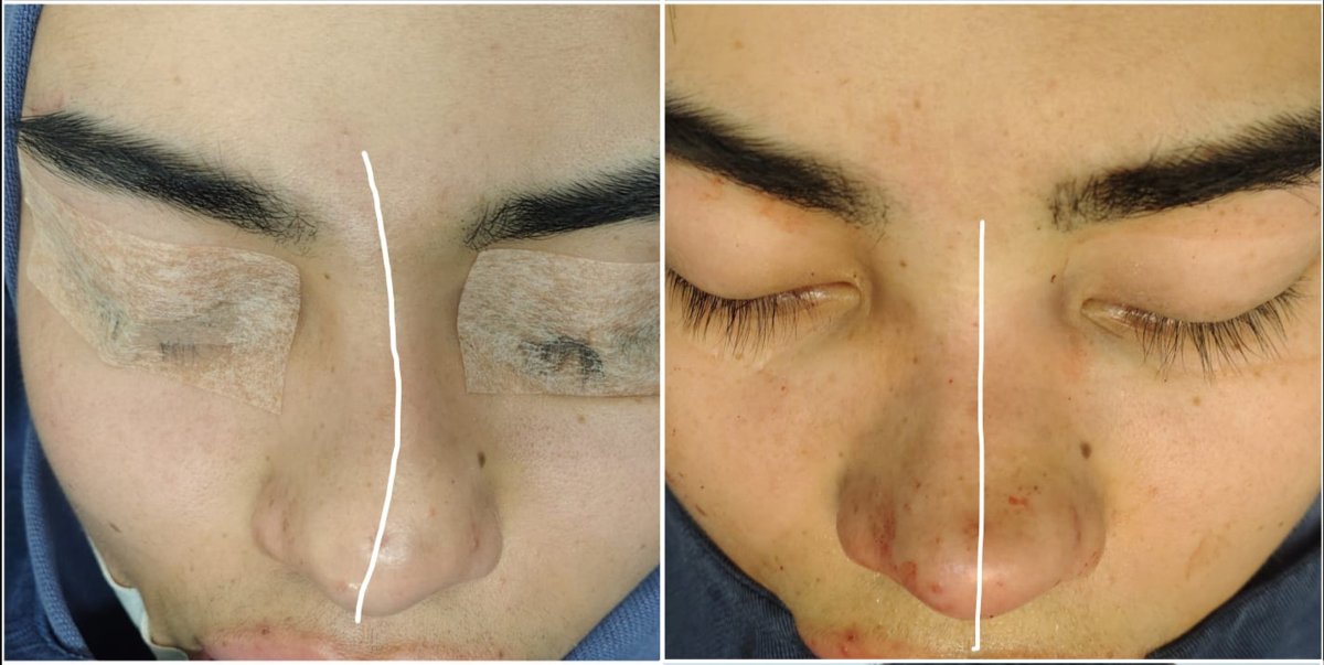 Resultados de rinoplastia antes y después, mejor simetría y alineación nasal tras cirugía