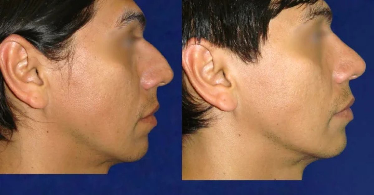 Before and after rhinoplasty results in male patient, improved nose shape and profile