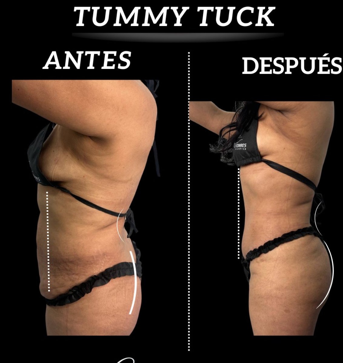 Before and after tummy tuck results – visible abdominal contour improvement