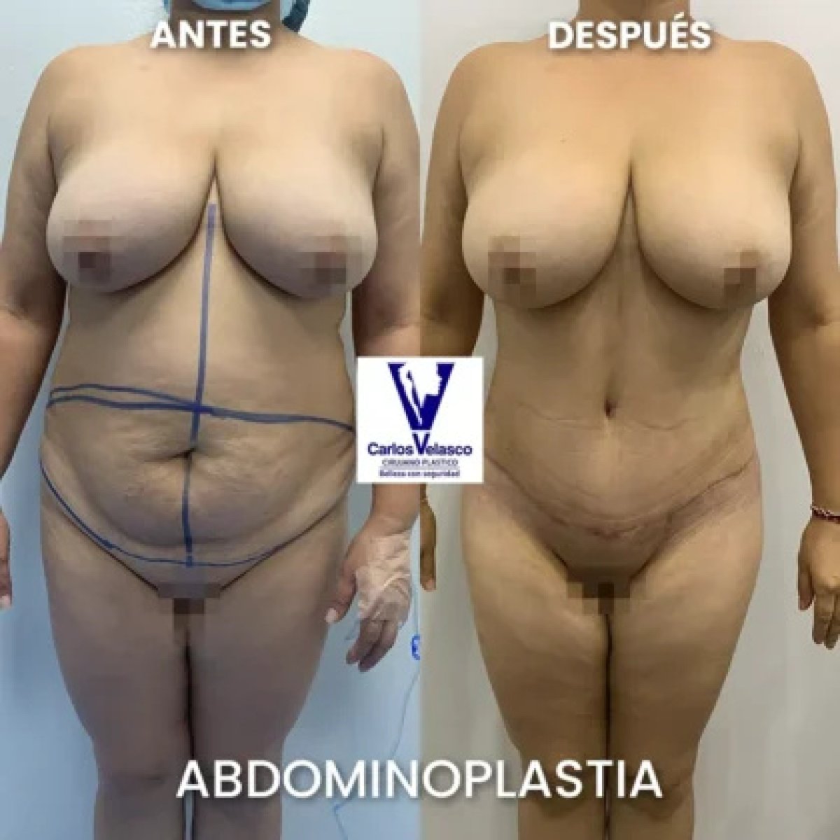 Before and after tummy tuck results at Carlos Velasco Clinic – improved abdominal contour
