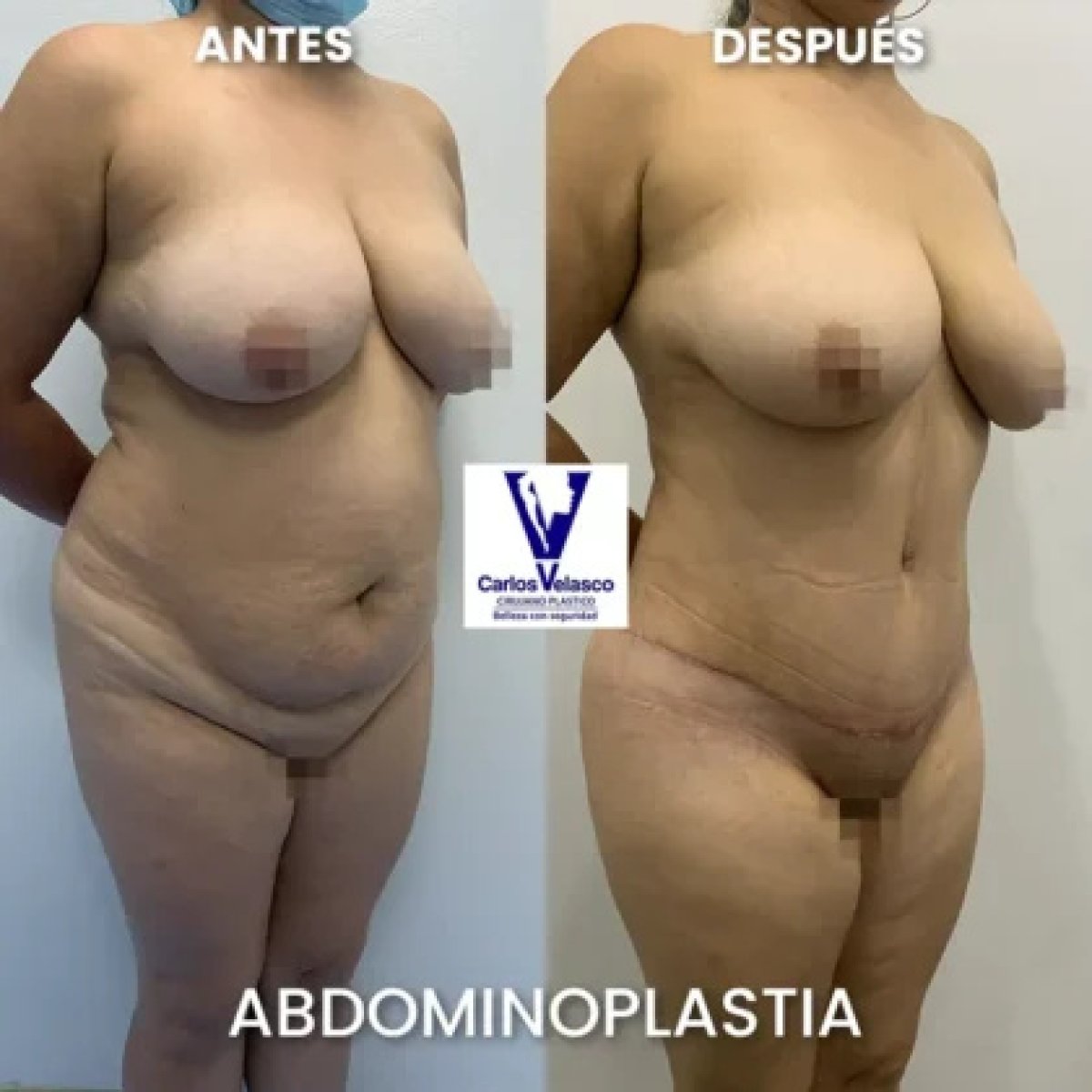 Before and after tummy tuck results at Carlos Velasco Clinic – visible abdominal contouring
