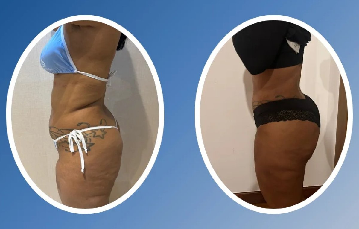 Resultados de abdominoplastia antes y después – mejor contorno abdominal y piel firme