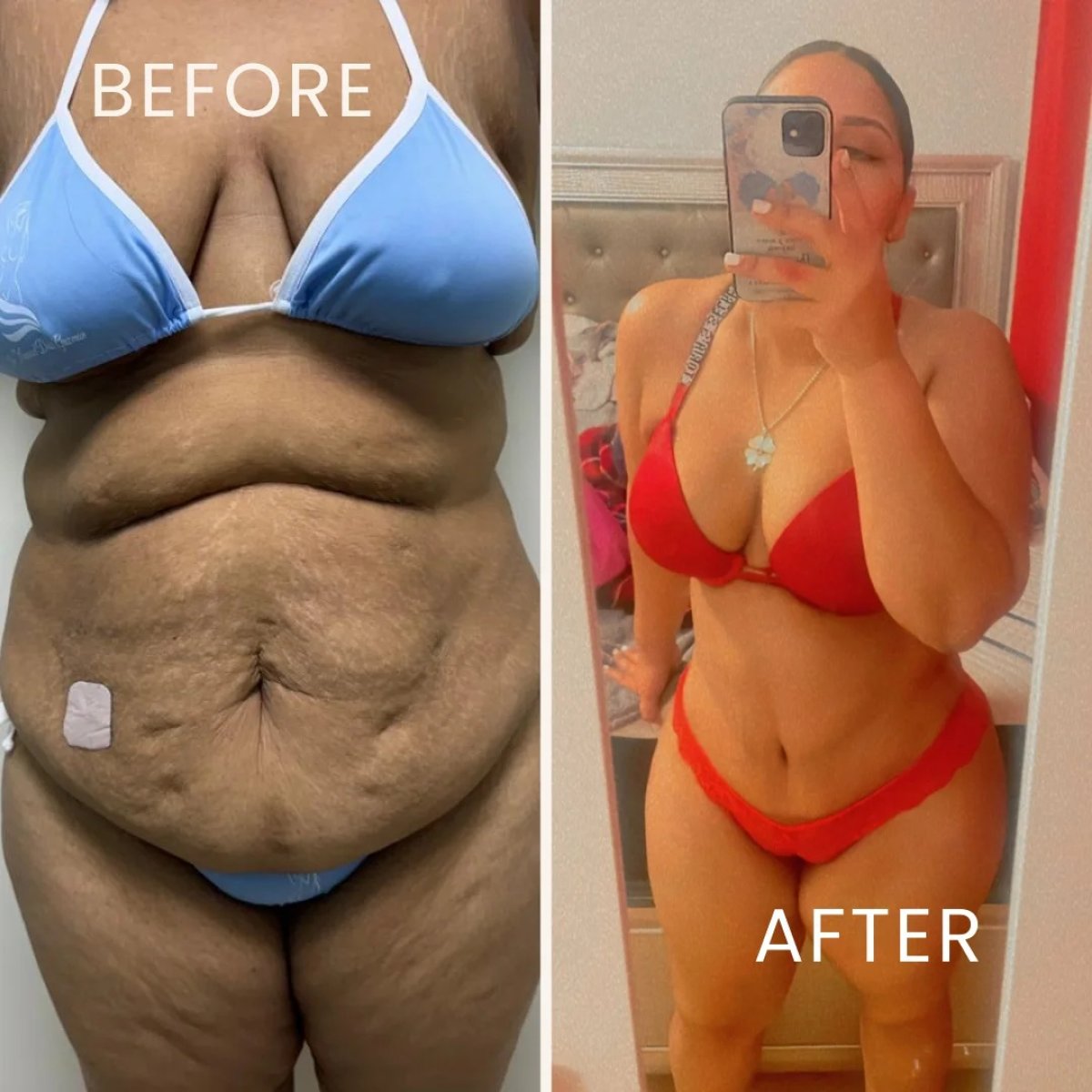 Resultados de abdominoplastia antes y después: mejora visible del contorno abdominal