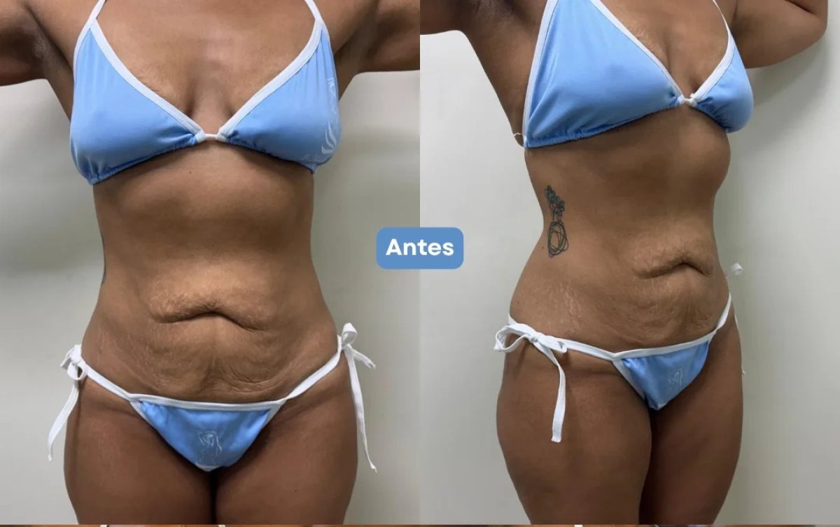 Resultados de abdominoplastia antes y después – mejora visible del contorno abdominal