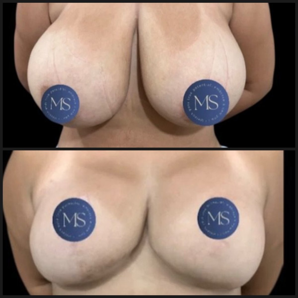 Before and after breast lift results at Dr. Michel Salameh - Plastic And Aesthetic Surgery