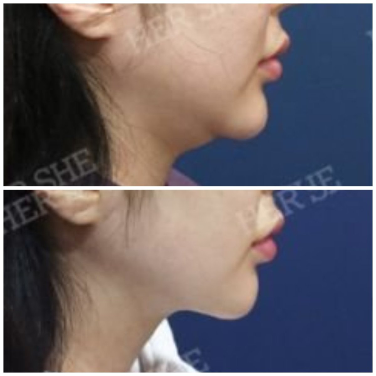 Before and after liposuction results at HERSHE Plastic Surgery Korea, improved jawline contour