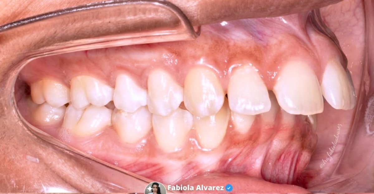 نتيجة قبل علاج التقويم – ازدحام الأسنان وعدم انتظامها في صورة الأسنان
