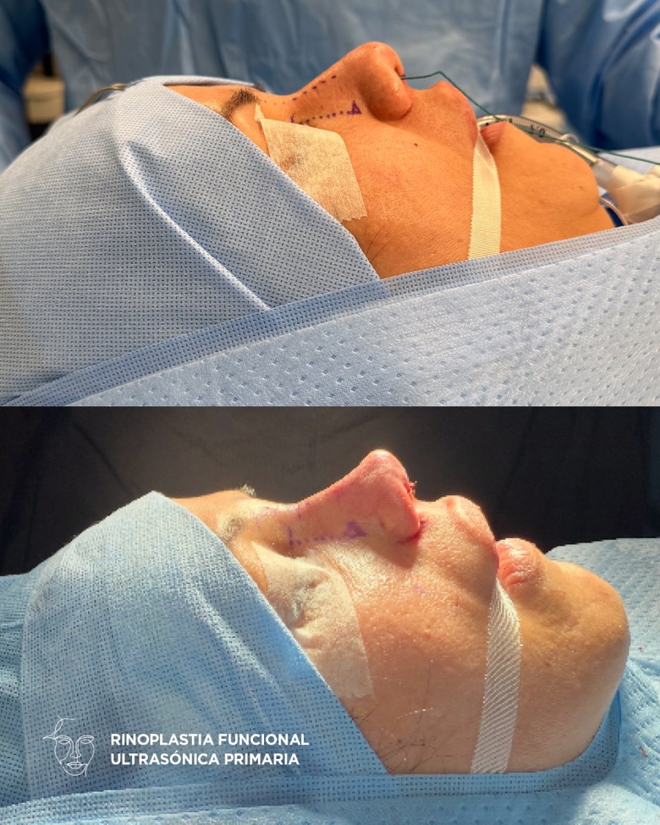 نتائج قبل وبعد عملية تجميل الأنف الوظيفية بالموجات فوق الصوتية، إعادة تشكيل الأنف