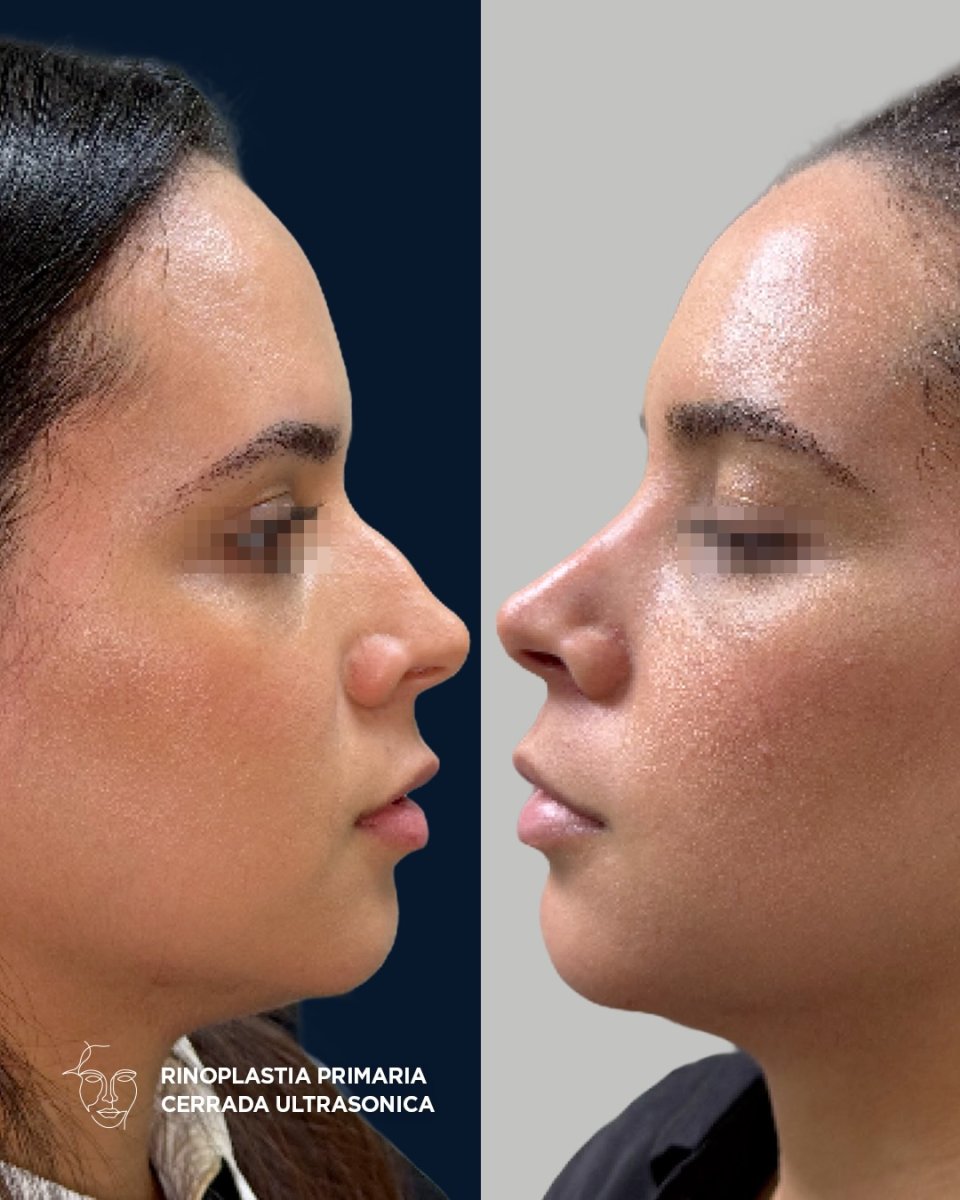 Vorher-nachher-Ergebnis der geschlossenen ultraschall-Rhinoplastik, natürliche Nasenform