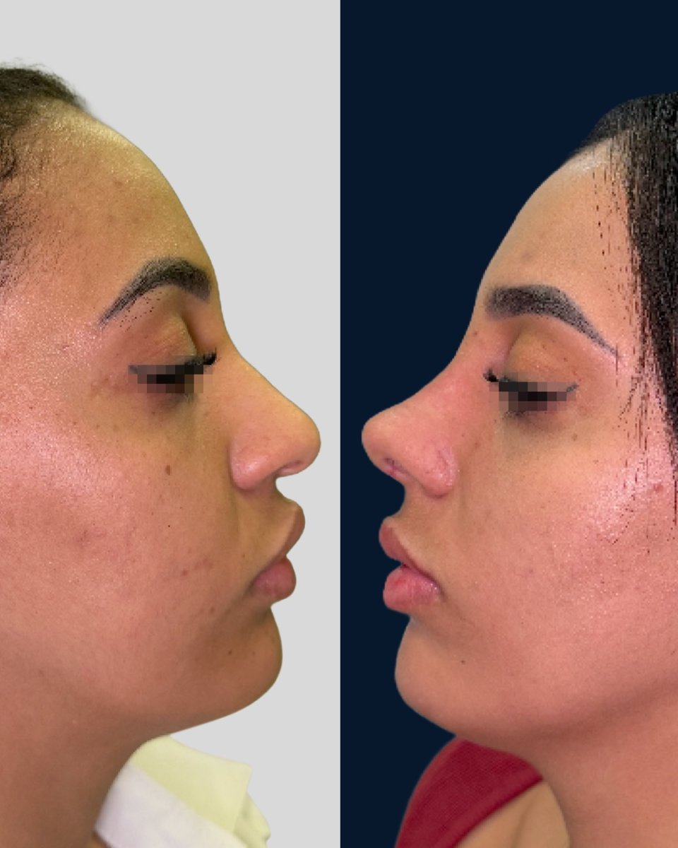 Vorher-nachher-Rhinoplastik, Nasenkorrektur für verbessertes Profil und Harmonie