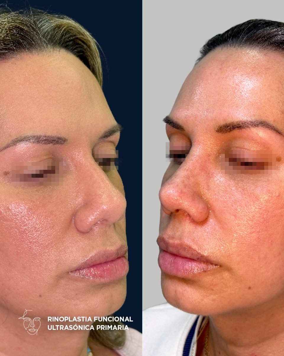 نتائج قبل وبعد عملية تجميل الأنف بالموجات فوق الصوتية، تحسين شكل الأنف وتناسق الوجه