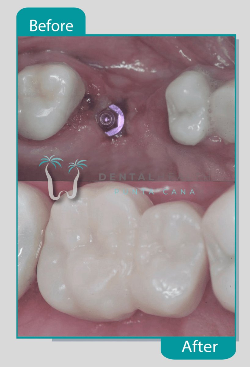 Результат до и после имплантации зуба в Dental Health Punta Cana – восстановленный моляр