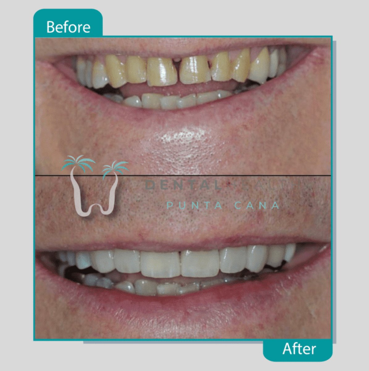 نتيجة الفينير قبل وبعد في Dental Punta Cana – ابتسامة بيضاء ومتناسقة