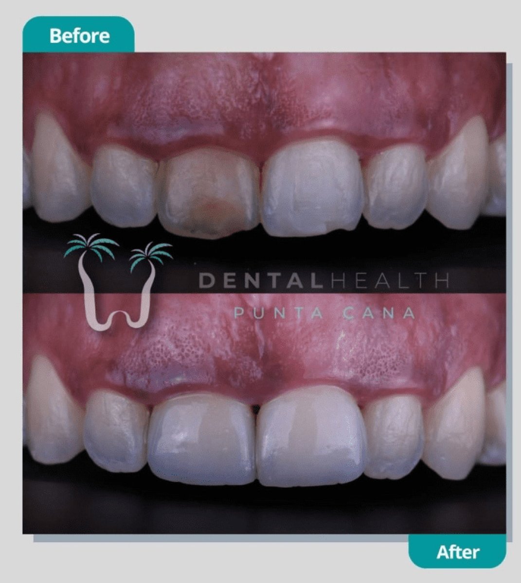 نتيجة الفينير قبل وبعد في Dental Health Punta Cana – تحسين جمالية الابتسامة