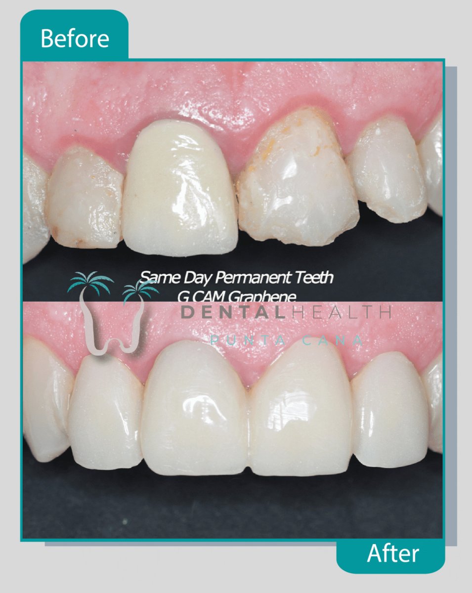 نتيجة الفينير قبل وبعد في Dental Health Punta Cana – تحول الابتسامة في نفس اليوم